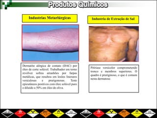 Industrias Metarlúrgicas 
Dermatite alérgica de contato (DAC) por 
óleo de corte solúvel. Trabalhador em torno 
revólver sofreu arranhões por farpas 
metálicas, que resultou em lesões linerares 
vesiculosas e prurigonosas. Teste 
epicutâneos positivos com óleo solúvel puro 
e diluído a 50% em óleo de oliva. 
Industria de Extração de Sal 
Pitíriase versicolor comprometendo 
tronco e membros superiores. O 
quadro é pruriginoso, o que é comum 
nesta dermatose. 
 