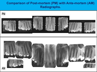 D. Caroline Mohamed 25
Comparison of Post-mortem (PM) with Ante-mortem (AM)
Radiographs.
 