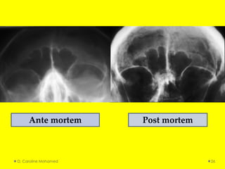 D. Caroline Mohamed 26
Ante mortem Post mortem
 