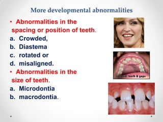 More developmental abnormalities
• Abnormalities in the
spacing or position of teeth.
a. Crowded,
b. Diastema
c. rotated or
d. misaligned.
• Abnormalities in the
size of teeth.
a. Microdontia
b. macrodontia.
 