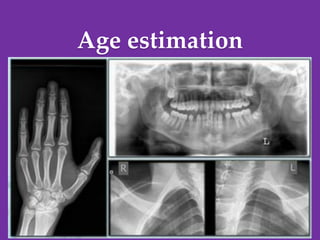 Age estimation
D. Caroline Mohamed 46
 