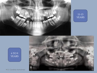 D. Caroline Mohamed 64
11-13
YEARS
6 TO 9
YEARS
 