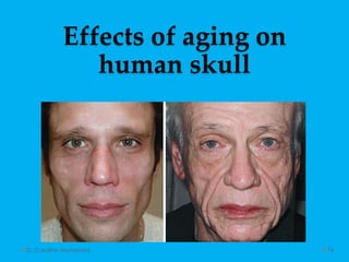 Effects of aging on
human skull
D. Caroline Mohamed 74
 