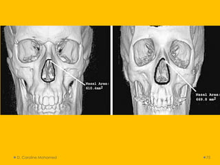 D. Caroline Mohamed 75
 