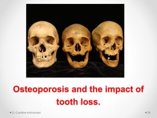 Osteoporosis and the impact of
tooth loss.
D. Caroline Mohamed 78
 