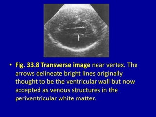 • Fig. 33.8 Transverse image near vertex. The
arrows delineate bright lines originally
thought to be the ventricular wall but now
accepted as venous structures in the
periventricular white matter.
 