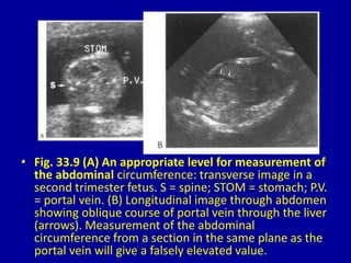 • Fig. 33.9 (A) An appropriate level for measurement of
the abdominal circumference: transverse image in a
second trimester fetus. S = spine; STOM = stomach; P.V.
= portal vein. (B) Longitudinal image through abdomen
showing oblique course of portal vein through the liver
(arrows). Measurement of the abdominal
circumference from a section in the same plane as the
portal vein will give a falsely elevated value.
 