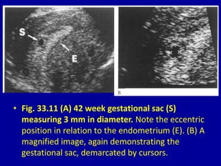 • Fig. 33.11 (A) 42 week gestational sac (S)
measuring 3 mm in diameter. Note the eccentric
position in relation to the endometrium (E). (B) A
magnified image, again demonstrating the
gestational sac, demarcated by cursors.
 