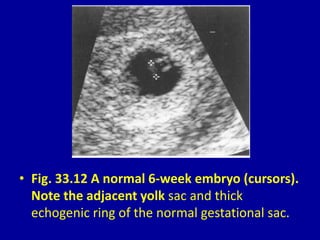 • Fig. 33.12 A normal 6-week embryo (cursors).
Note the adjacent yolk sac and thick
echogenic ring of the normal gestational sac.
 