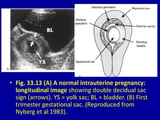• Fig. 33.13 (A) A normal intrauterine pregnancy:
longitudinal image showing double decidual sac
sign (arrows). YS = yolk sac; BL = bladder. (B) First
trimester gestational sac. (Reproduced from
Nyberg et al 1983).
 
