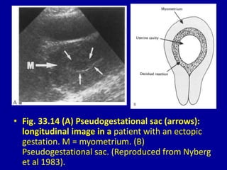 • Fig. 33.14 (A) Pseudogestational sac (arrows):
longitudinal image in a patient with an ectopic
gestation. M = myometrium. (B)
Pseudogestational sac. (Reproduced from Nyberg
et al 1983).
 