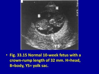 • Fig. 33.15 Normal 10-week fetus with a
crown-rump length of 32 mm. H=head,
B=body, YS= yolk sac.
 