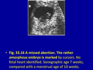 • Fig. 33.16 A missed abortion. The rather
amorphous embryo is marked by cursors. No
fetal heart identified. Sonographic age 7 weeks,
compared with a menstrual age of 10 weeks.
 
