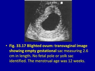 • Fig. 33.17 Blighted ovum: transvaginal image
showing empty gestational sac measuring 2.6
cm in length. No fetal pole or yolk sac
identified. The menstrual age was 12 weeks.
 