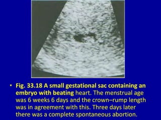• Fig. 33.18 A small gestational sac containing an
embryo with beating heart. The menstrual age
was 6 weeks 6 days and the crown–rump length
was in agreement with this. Three days later
there was a complete spontaneous abortion.
 