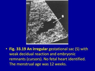 • Fig. 33.19 An irregular gestational sac (S) with
weak decidual reaction and embryonic
remnants (cursors). No fetal heart identified.
The menstrual age was 12 weeks.
 