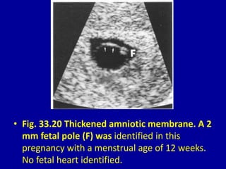 • Fig. 33.20 Thickened amniotic membrane. A 2
mm fetal pole (F) was identified in this
pregnancy with a menstrual age of 12 weeks.
No fetal heart identified.
 