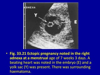 • Fig. 33.21 Ectopic pregnancy noted in the right
adnexa at a menstrual age of 7 weeks 3 days. A
beating heart was noted in the embryo (E) and a
yolk sac (Y) was present. There was surrounding
haematoma.
 
