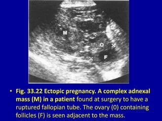 • Fig. 33.22 Ectopic pregnancy. A complex adnexal
mass (M) in a patient found at surgery to have a
ruptured fallopian tube. The ovary (0) containing
follicles (F) is seen adjacent to the mass.
 