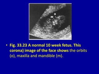 • Fig. 33.23 A normal 10 week fetus. This
corona) image of the face shows the orbits
(o), maxilla and mandible (m).
 