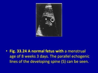 • Fig. 33.24 A normal fetus with a menstrual
age of 8 weeks 3 days. The parallel echogenic
lines of the developing spine (S) can be seen.
 