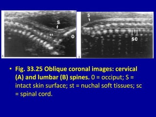 • Fig. 33.25 Oblique coronal images: cervical
(A) and lumbar (B) spines. 0 = occiput; S =
intact skin surface; st = nuchal soft tissues; sc
= spinal cord.
 