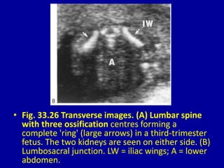 • Fig. 33.26 Transverse images. (A) Lumbar spine
with three ossification centres forming a
complete 'ring' (large arrows) in a third-trimester
fetus. The two kidneys are seen on either side. (B)
Lumbosacral junction. LW = iliac wings; A = lower
abdomen.
 