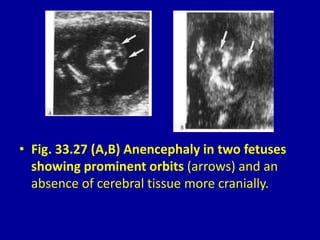 • Fig. 33.27 (A,B) Anencephaly in two fetuses
showing prominent orbits (arrows) and an
absence of cerebral tissue more cranially.
 