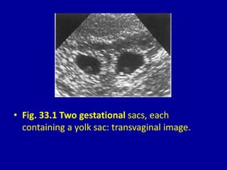 • Fig. 33.1 Two gestational sacs, each
containing a yolk sac: transvaginal image.
 