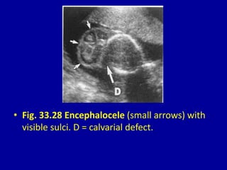 • Fig. 33.28 Encephalocele (small arrows) with
visible sulci. D = calvarial defect.
 