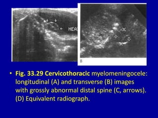 • Fig. 33.29 Cervicothoracic myelomeningocele:
longitudinal (A) and transverse (B) images
with grossly abnormal distal spine (C, arrows).
(D) Equivalent radiograph.
 