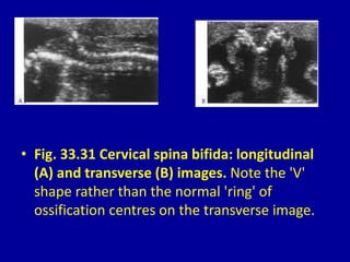 • Fig. 33.31 Cervical spina bifida: longitudinal
(A) and transverse (B) images. Note the 'V'
shape rather than the normal 'ring' of
ossification centres on the transverse image.
 