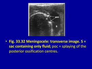 • Fig. 33.32 Meningocele: transverse image. S =
sac containing only fluid; poc = splaying of the
posterior ossification centres.
 