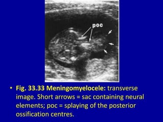 • Fig. 33.33 Meningomyelocele: transverse
image. Short arrows = sac containing neural
elements; poc = splaying of the posterior
ossification centres.
 