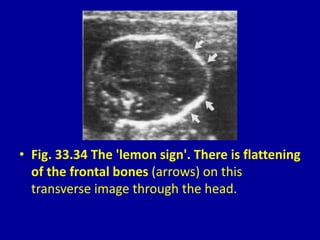 • Fig. 33.34 The 'lemon sign'. There is flattening
of the frontal bones (arrows) on this
transverse image through the head.
 
