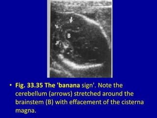 • Fig. 33.35 The 'banana sign'. Note the
cerebellum (arrows) stretched around the
brainstem (B) with effacement of the cisterna
magna.
 
