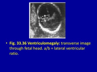 • Fig. 33.36 Ventriculomegaly: transverse image
through fetal head. a/b = lateral ventricular
ratio.
 
