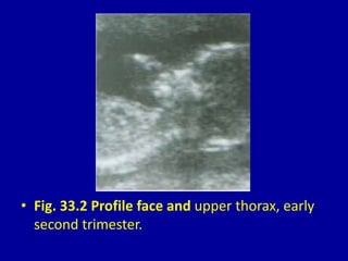 • Fig. 33.2 Profile face and upper thorax, early
second trimester.
 