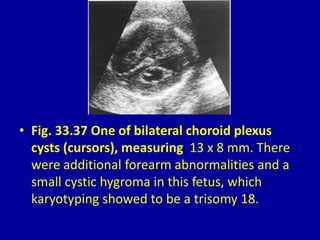 • Fig. 33.37 One of bilateral choroid plexus
cysts (cursors), measuring 13 x 8 mm. There
were additional forearm abnormalities and a
small cystic hygroma in this fetus, which
karyotyping showed to be a trisomy 18.
 