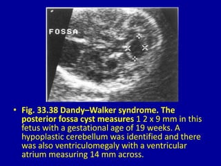 • Fig. 33.38 Dandy–Walker syndrome. The
posterior fossa cyst measures 1 2 x 9 mm in this
fetus with a gestational age of 19 weeks. A
hypoplastic cerebellum was identified and there
was also ventriculomegaly with a ventricular
atrium measuring 14 mm across.
 