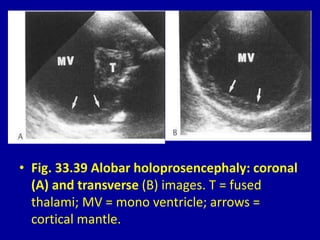 • Fig. 33.39 Alobar holoprosencephaly: coronal
(A) and transverse (B) images. T = fused
thalami; MV = mono ventricle; arrows =
cortical mantle.
 