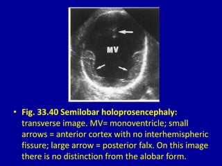• Fig. 33.40 Semilobar holoprosencephaly:
transverse image. MV= monoventricle; small
arrows = anterior cortex with no interhemispheric
fissure; large arrow = posterior falx. On this image
there is no distinction from the alobar form.
 