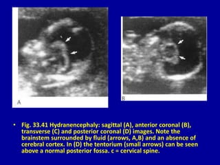 • Fig. 33.41 Hydranencephaly: sagittal (A), anterior coronal (B),
transverse (C) and posterior coronal (D) images. Note the
brainstem surrounded by fluid (arrows, A,B) and an absence of
cerebral cortex. In (D) the tentorium (small arrows) can be seen
above a normal posterior fossa. c = cervical spine.
 