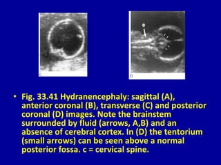 • Fig. 33.41 Hydranencephaly: sagittal (A),
anterior coronal (B), transverse (C) and posterior
coronal (D) images. Note the brainstem
surrounded by fluid (arrows, A,B) and an
absence of cerebral cortex. In (D) the tentorium
(small arrows) can be seen above a normal
posterior fossa. c = cervical spine.
 