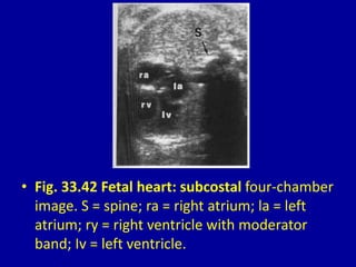 • Fig. 33.42 Fetal heart: subcostal four-chamber
image. S = spine; ra = right atrium; la = left
atrium; ry = right ventricle with moderator
band; Iv = left ventricle.
 