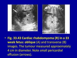 • Fig. 33.43 Cardiac rhabdomyoma (R) in a 33
week fetus: oblique (A) and transverse (B)
images. The tumour measured approximately
4 cm in diameter. Note small pericardial
effusion (arrows).
 
