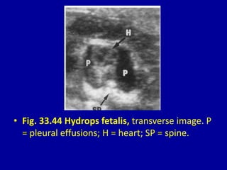 • Fig. 33.44 Hydrops fetalis, transverse image. P
= pleural effusions; H = heart; SP = spine.
 