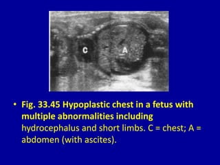 • Fig. 33.45 Hypoplastic chest in a fetus with
multiple abnormalities including
hydrocephalus and short limbs. C = chest; A =
abdomen (with ascites).
 