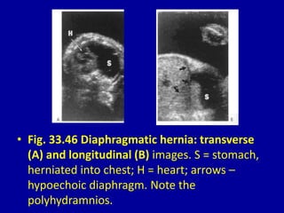 • Fig. 33.46 Diaphragmatic hernia: transverse
(A) and longitudinal (B) images. S = stomach,
herniated into chest; H = heart; arrows –
hypoechoic diaphragm. Note the
polyhydramnios.
 