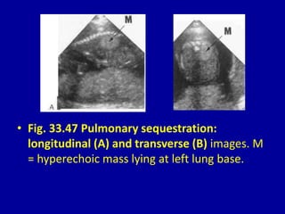 • Fig. 33.47 Pulmonary sequestration:
longitudinal (A) and transverse (B) images. M
= hyperechoic mass lying at left lung base.
 